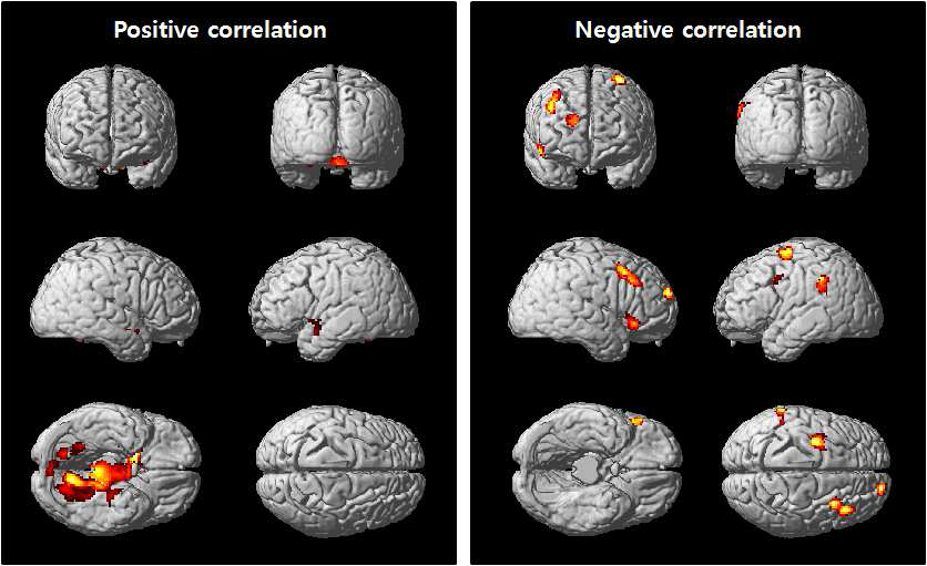 Rendered images of positive correlations (left) and negative correlations (right) between glucose metabolism (resting brain activity) and impulsivity for male subjects(p<0.005, uncorrected k=100).