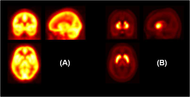 O-15-Water를 이용한 뇌 PET 영상의 공간정규화에 사용되는 뇌 PET 템플릿(A)과 F-18-fallypride를 이용한 뇌 PET 영상의 공간정규화에 사용되는 뇌 PET 템플릿(B) 비교.
