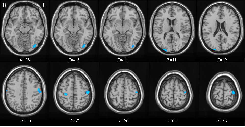 Brain regions showing lower glucose metabolism in the Internet game overusers (n=11) than in the normal users (n=9) (P < .001 uncorrected, k = 20).