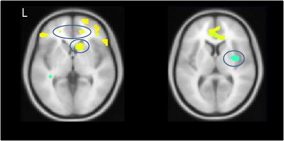 좌: 인터넷 중독 집단에 비해 정상 성인 집단에서 기능적 연결성이 증가된 뇌 영역. 우: 정상 성인 집단에 비해 인터넷 중독 집단에서 기능적 연결성이 저하된 뇌 영역.