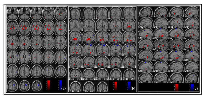 T1 weighted brain MRI template를 이용해 PTSD환자의 뇌와 정상인의 뇌를 비교한 결과