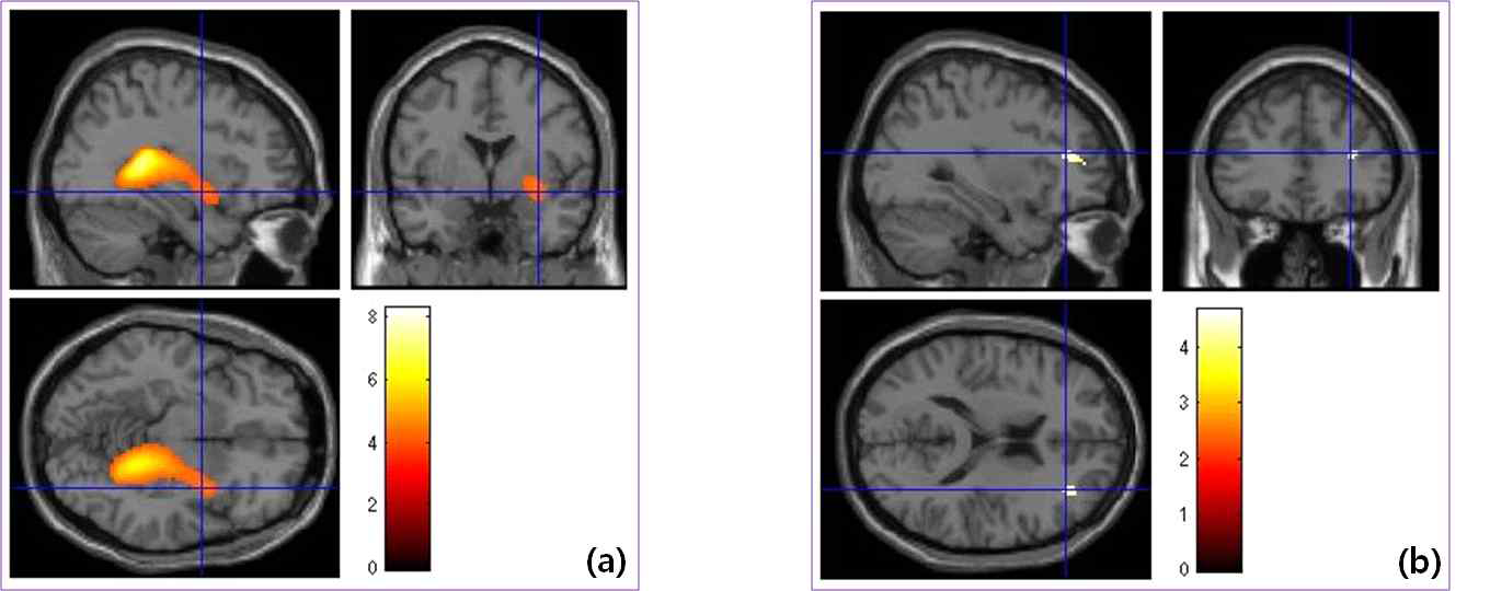 분열형 인격성향군의 P200(a), P400(b) component에서 감소된 뇌 영역
