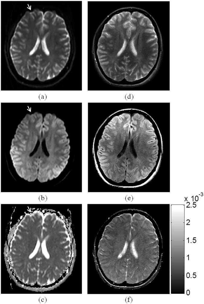 (a-c) 기존의 확산 강조 영상법으로 얻어진 T2 강조 영상, 확산 강조 영상, ADC map, (d-f) 제안하는 방법으로 얻어진 T2 강조 영상, 확산 강조 영상, ADC map.