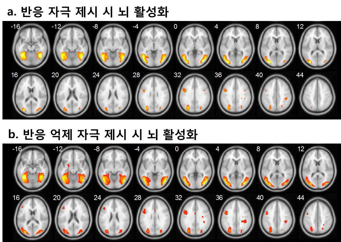 반응 억제자극 제시 시 집단분석 결과(성중독군 > 정상대조군)