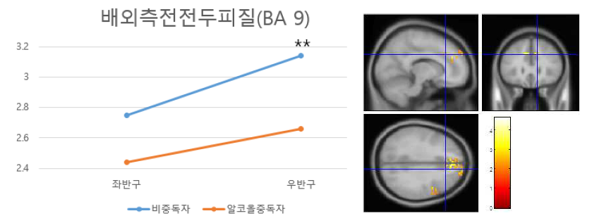 배외측전전두피질(BA 9)에서 알코올 중독자의 체적 감소.