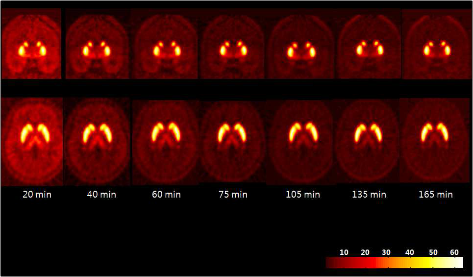 [18F]Fallypride 대뇌 섭취 영상