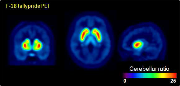 [18F]fallypride의 결합능 (BPND ) 영상