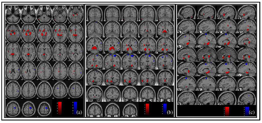 T1 weighted brain MRI template를 이용해 PTSD환자의 뇌와 정상인의 뇌를 비교한 결과