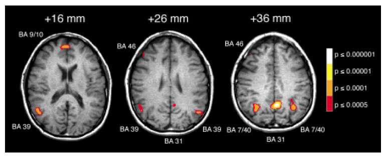 도덕적 딜레마의 종류에 따라 서로 다르 게 반응하는 뇌 영역들. (Greene et al., 2001)