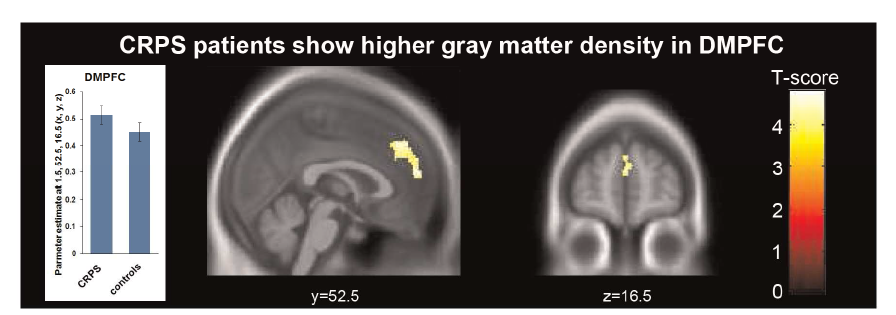 복합부위통증증후군 환자들의 회백질 밀도 이상 (Ploghaus et al., 2014)