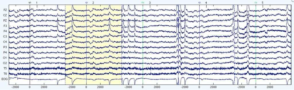 EOG Noise 제거 전 EEG signals