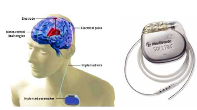 뇌심부 자극술 시스템