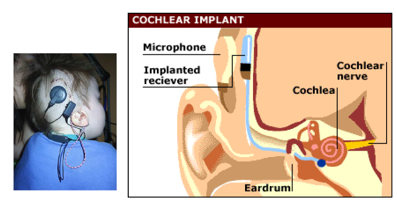 인공 와우 시술 받은 아이 및 인공 와우의 내부 구조