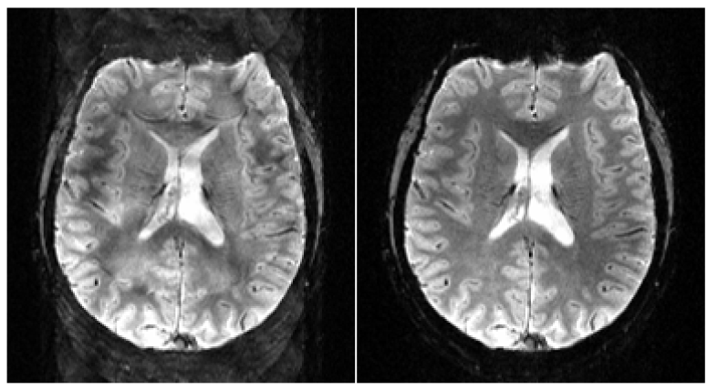 (좌) 일반적인 방법으로 재구성된 뇌 영상과 (우) amplitude correction을 추가하여 재구성된 뇌 영상
