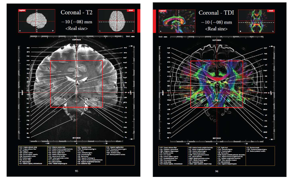 TDI를 이용한 뇌연결구조 지도