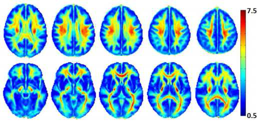 ViSTa Myelin Water Imaging방법을 이용해 완성된 두뇌 전체의 Myelin 지도