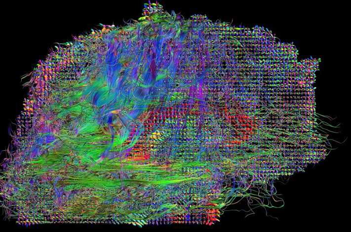 HARDI (High Angular Resolution Diffusion Imaging) 트랙 : 오른쪽, 왼쪽 반구의 이동 정보