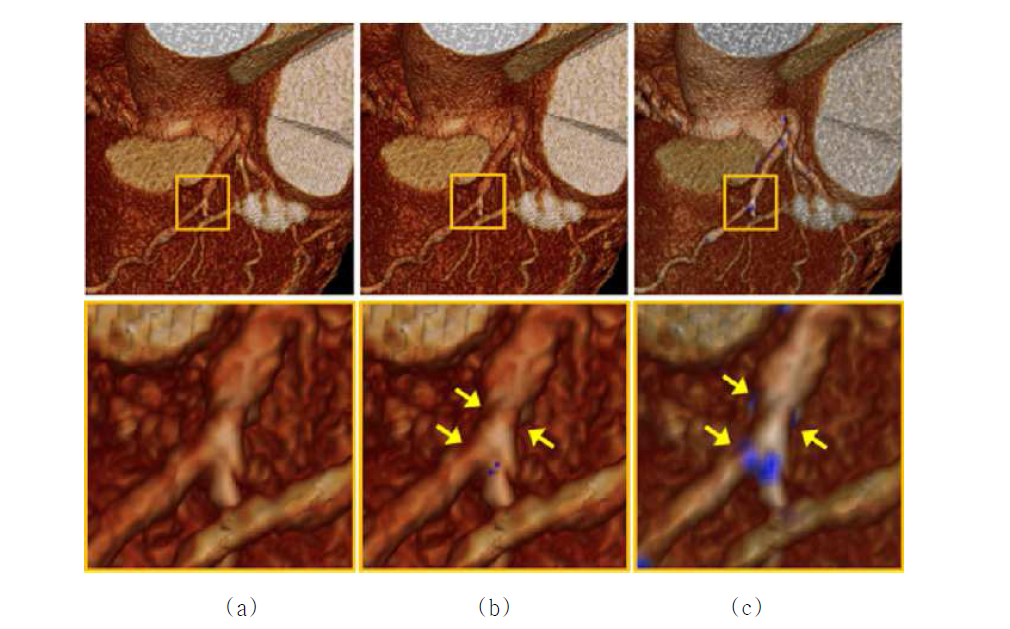 관상 동맥 협착 가시화 알고리즘 결과. (a) 일반적인 3차원 볼륨 렌더링 결과 (관상동맥 내 협착 영역이 혈관에 가려 보이질 않음). (b) 고안한 fusion-rendering 결과 (σ = 1.0). (c) 고안한 fusion-rendering 결과 (σ = 0.4). 그림에서 알 수 있듯이 값을 조절하면서 관상 동맥 내의 협착을 원하는 수준으로 눈에 띄게 가시화 가능함.