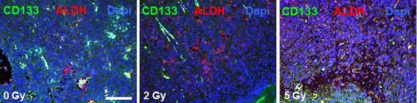 An expression of CD133 or ALDH on Lung adenocarcinoma PDX tumors after IR