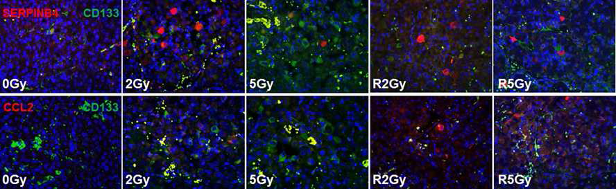 Expression of SerpinB4 or Ccl2 on tumor tissues