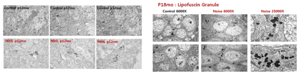 18개월까지의 장기 추적 관찰 후 난청 동물의 해마 조직: 난청 동물에서 대조군에 비해 p-Tau 및 lipofuscin granule의 발현량이 현저히 증가됨을 TEM * ImmnoTEM 연구기법을 통해 세계 최초로 관찰함.