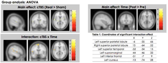 실제 cTBS 자극과 샴자극간 활성 영역의 차이