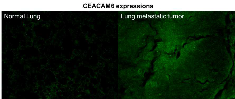 정상 폐 조직과 폐에 전이된 암 조직에서의 CEACAM6 발 현을 보여주는 형광 Immunohistochemistry (IHC) 결과.