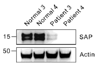 XLP1 NK cell은 SAP 발현이 결여되어 있음. 추가된 XLP1 patient의 NK cell에서 SAP발현을 확인한 결과 현저히 발현이 결여되어 있음을 확인함.