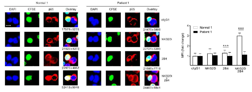 XLP1 NK cell은 NKG2D와 2B4의 coactivation에 의한 p65의 nuclear translocation이 결여되어 있음. XLP1 NK cell은 정상인 NK cell에 비해 NKG2D와 2B4 시너지 자극 target에 의한 p65 nuclear translocation 작용이 떨어짐을 confocal microscopy로 확인함.