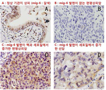비소세포 폐암 환자조직에서 Mig 6 발현
