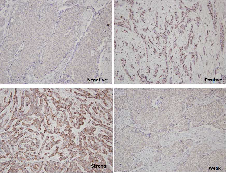 Immunohistochemical staining of PI4K in human breast cancer samples