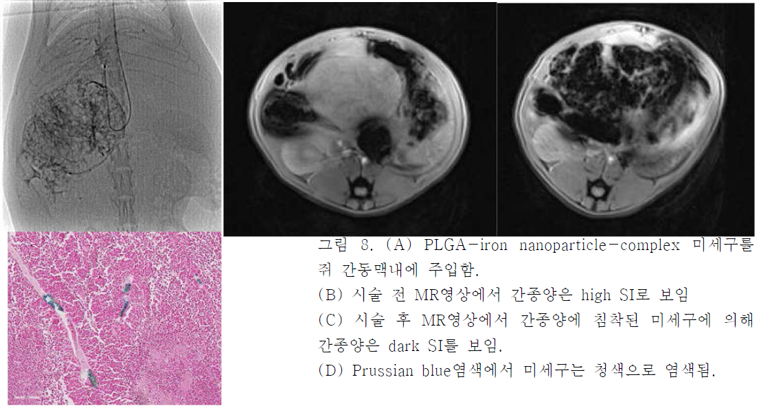 (A) PLGA-iron nanoparticle-complex 미세구를 쥐 간동맥내에 주입함. (B) 시술 전 MR영상에서 간종양은 high SI로 보임 (C) 시술 후 MR영상에서 간종양에 침착된 미세구에 의해 간종양은 dark SI를 보임. (D) Prussian blue염색에서 미세구는 청색으로 염색됨