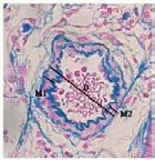 Medial thickness of pulmonary arteriole.