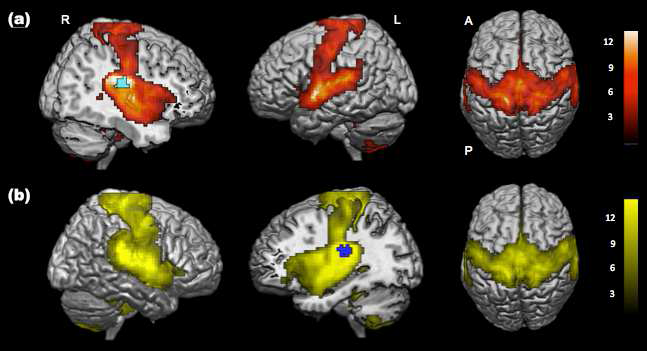 정상성인에서 (a) R OP2에 대한 functional connectivity (빨강), (b) L OP2에 대한 functional connectivity (노랑) 결과