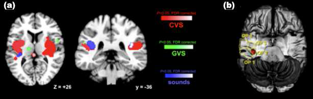 메타분석 결과 (a) 3가지 의 전정관련 자극을 통해 확인된 피질 영역 (Lopez C et al., 2012), (b) primary vestibular cortex 추정된 OP2의 해부학적 위 치