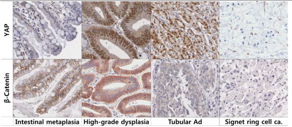 Representative Yes-associated protein (YAP) and beta-catenin expression in intestinal metaplasia, high-grade dysplasia, tubular adenocarcinoma (Ad) and signet ring cell carcinoma (ca.) of the stomach as revealed by immunohistochemical staining (magnification,x400).
