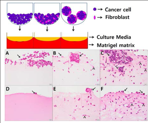Tumour invasion assays using a 3D organotypic cell culture model with a basement membrane matrix (BD Matrigel􎞱) after a 4-day culture.