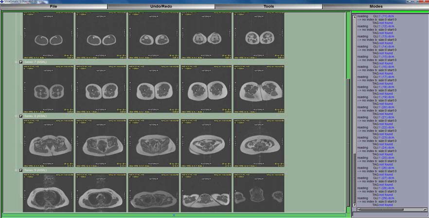 Slice-O-matic을 이용한 전신 MRI scan 분석 영상