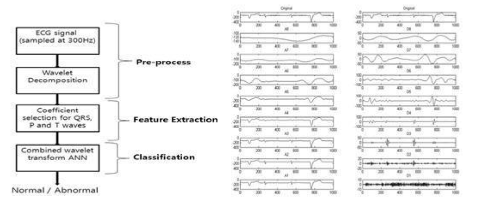 wavelet transformation analysis를 이용한 부정맥 분석방법