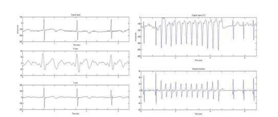 Wavelet transformation을 이용한 심실성빈맥 분석방법