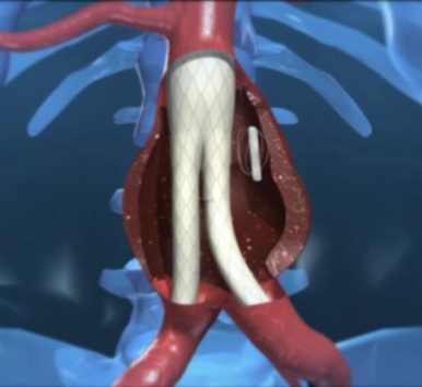 Cardiomems의 혈압 센서