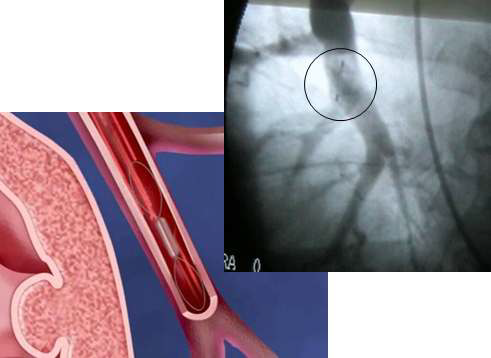 Cardiomems의 Heart Failure 진단 센서