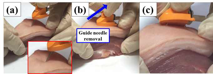 돼지 피부 조직을 통한 가이드 바늘의 센서 삽입 테스트