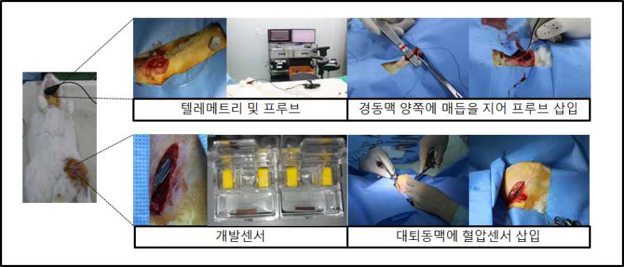 혈압센서 센서 및 텔레메트리 프루브 삽입