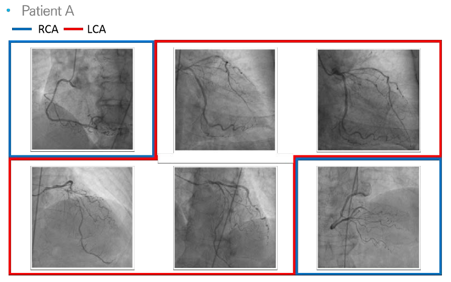 한 환자의 CAG 영상들을 정합을 통해 해부학적 정보로 분류한 결과
