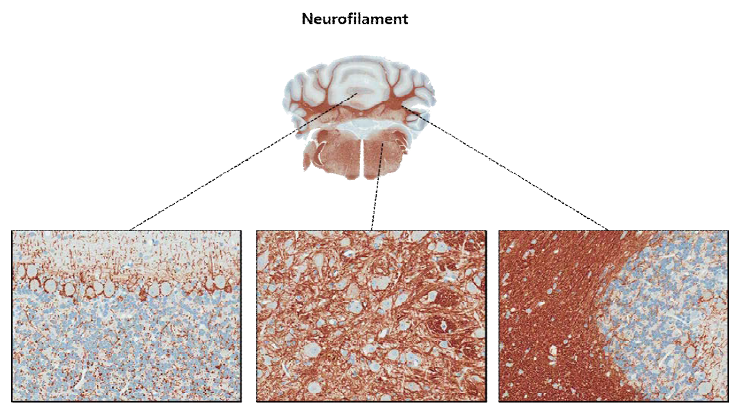 Neurofilament(M chain); 신경원 세포는 염색되지 않고 신경원에서 나오는 액손과 수상돌기가 주로 양성반응을 나타냄.