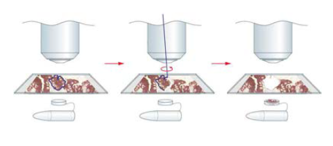 Laser capture microdissection장비를 사용한 암세포의 분리