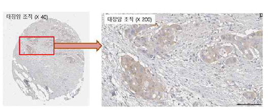 대장암 조직에서의 CAPN2 발현