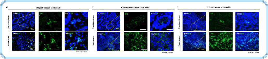 다양한 암에 대한 임상 조직 분석을 통한 PAI의 발암성 검증