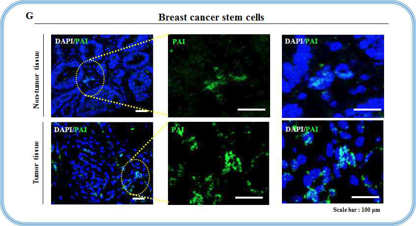 유방암 조직에서 PAI의 발현과 발암성의 상관 관계 검증
